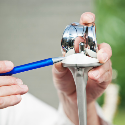 Wanneer Is Het Nodig Om Een Knieprothese Te Vervangen Alles Over De Revisie Van Een Totale Knieprothese