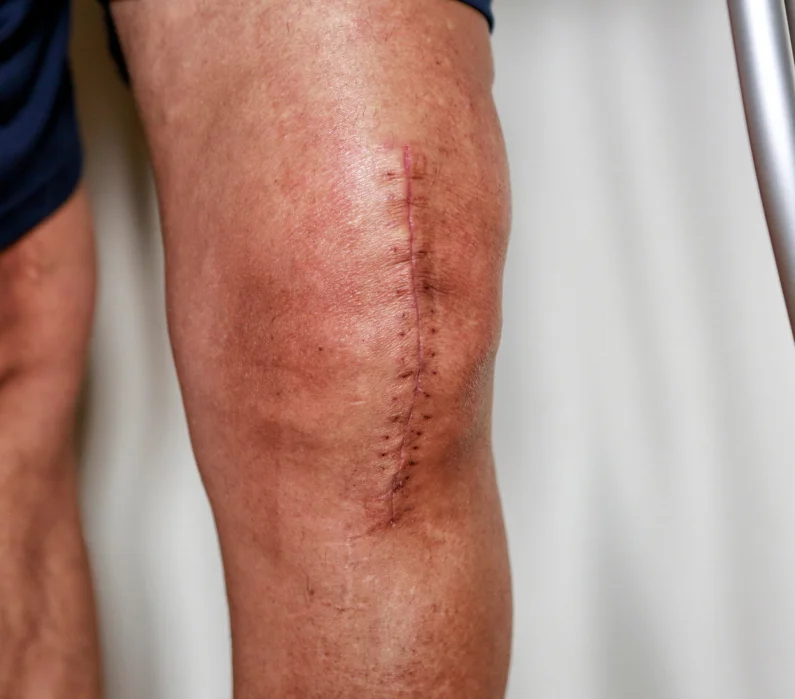 ViefLeven na een knie prothese